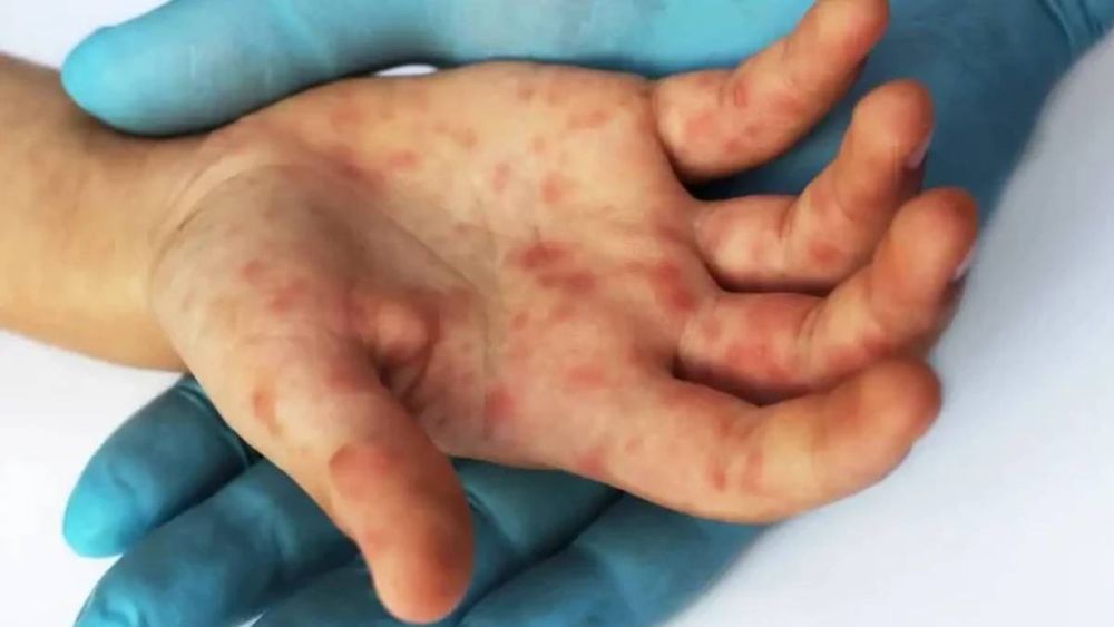 Viruela del mono: qué es, síntomas y cómo se contagia