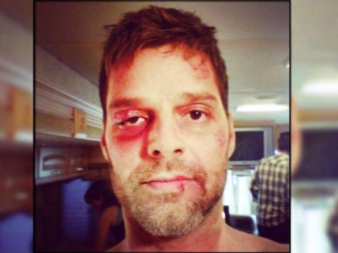 Ricky Martin ¿golpeado?