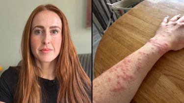 Se hospedó una noche en un hotel de Reino Unido y despertó cubierta de picaduras de chinches.