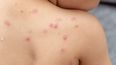 Viruela del mono: tiene baja contagiosidad y letalidad