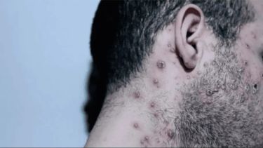 Según el estudio, El 95% de los casos de viruela del mono se transmitió a través de actividad sexual.