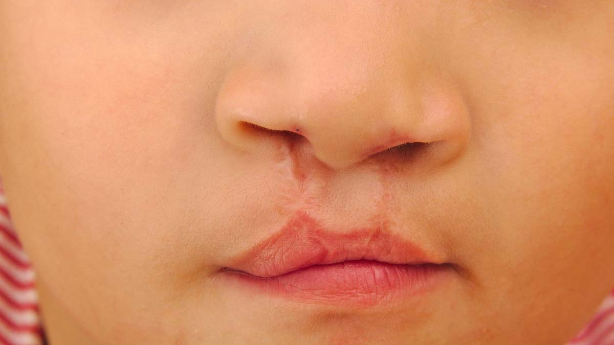 De 19 a 25 casos anuales en Jujuy: fisura de labio alvéolo palatina