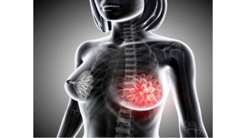 Cáncer de mama