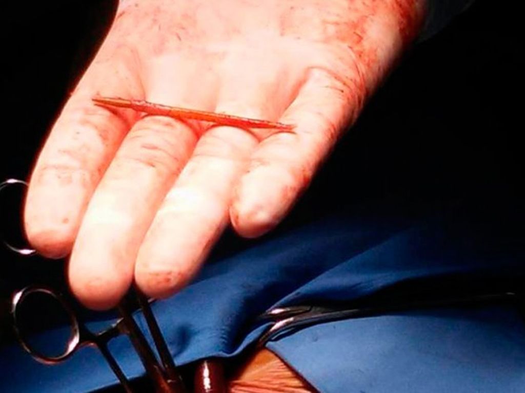 escarbadientes encontrado en un corazón