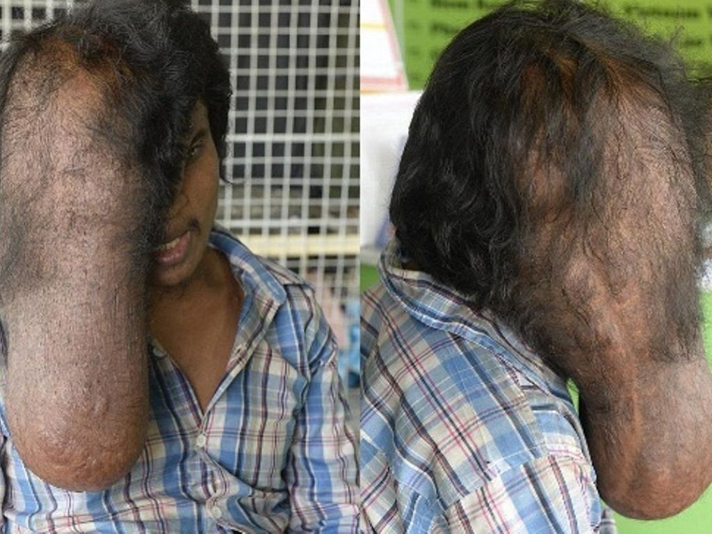 El tumor será extirpado