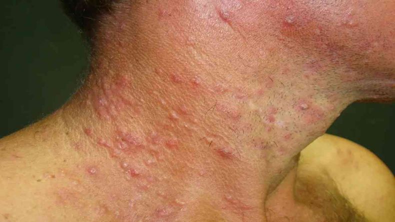 Aumento de sífilis en Salta (Foto ilustrativa)