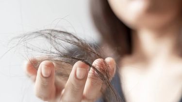 Hay un tratamiento nuevo para los pacientes más jóvenes con una pérdida de cabello considerable.