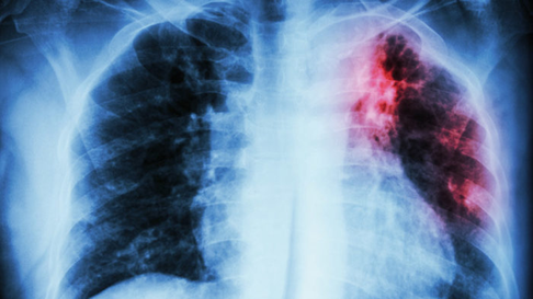 Todo Jujuy | Tuberculosis
