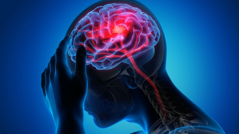 Accidente Cerebro Vascular (ACV)