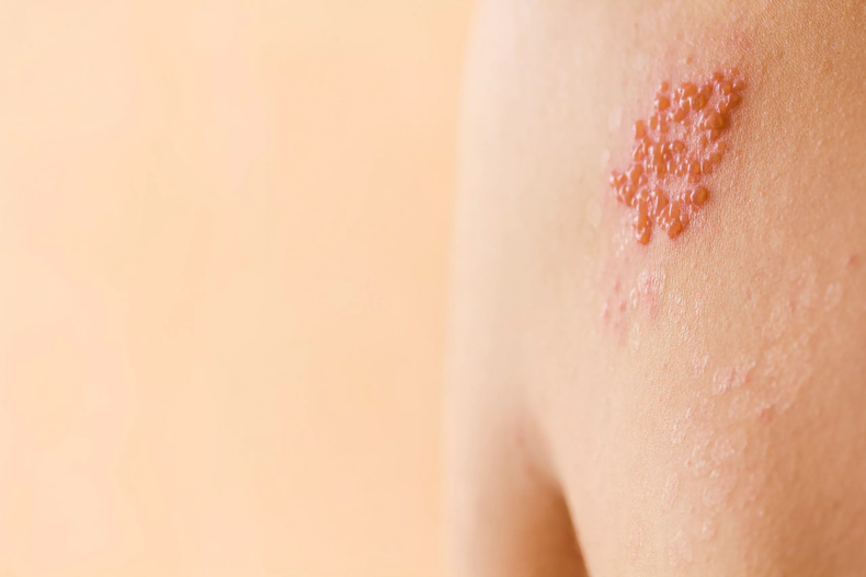 Caracterizado por la aparición de erupciones cutáneas en unas o más partes del cuerpo, el herpes zóster puede definirse clínicamente como una dermatosis aguda, causada por el virus VVZ (Virus Varicela-Zóster), el mismo que provoca la varicela.