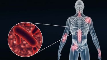Día Mundial de la Tuberculosis.