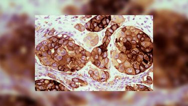 La vacuna argentina contra el cáncer de piel más agresivo ya está disponible.