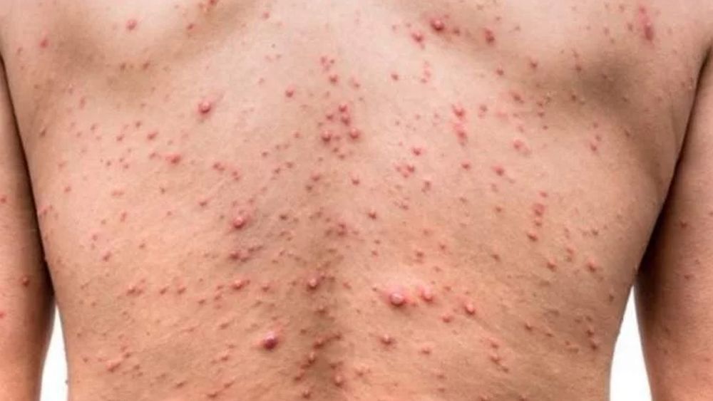 Si la sífilis no se la trata correctamente a tiempo puede provocar un dolor permanente para toda la vida.