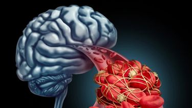 El 60% de la población no sabe cómo actuar ante un accidente cerebrovascular. &nbsp;