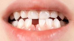Dientes de leche.