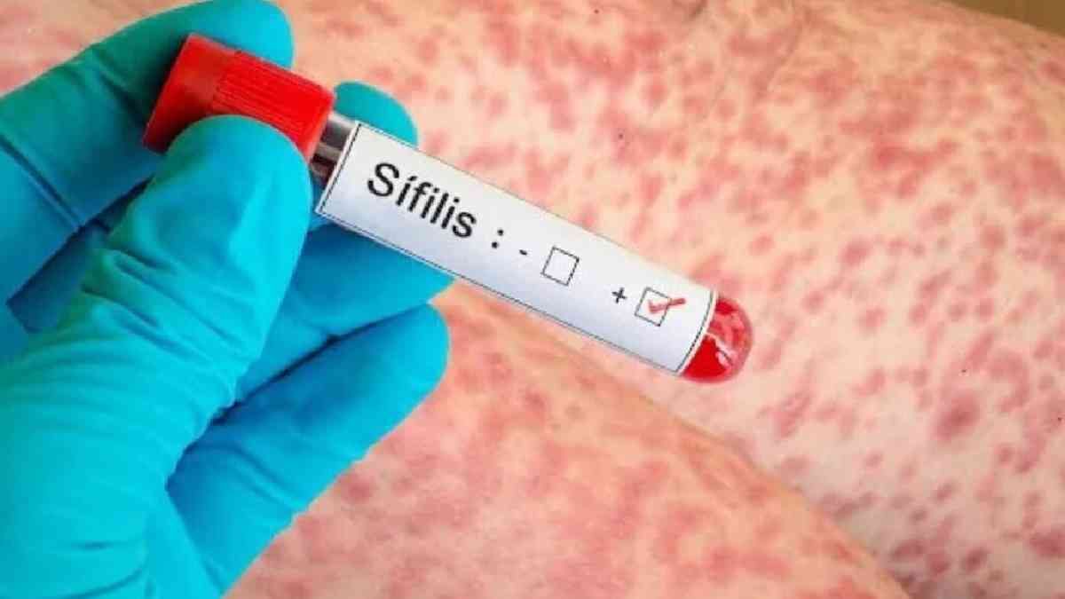 Más contagios de sífilis en Argentina (Foto ilustrativa)