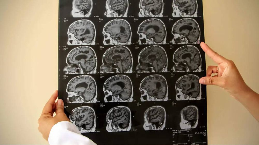 Qué enfermedad tenía el Indio Solari: la explicación de un experto en Ciencias Biológicas
