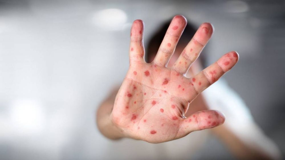 Qué es el sarampión y cómo se contagia: los puntos clave para tener en cuenta