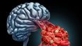 El 60% de la población no sabe cómo actuar ante un accidente cerebrovascular. &nbsp;