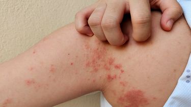 Alerta sanitaria por lepra en el norte: explican síntomas y cuidados tras nuevos casos en Orán