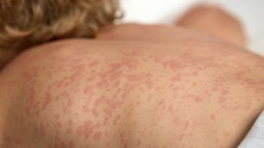 El ministerio emitió alerta por sarampión: cuál es la situación de Jujuy El ministerio emitió alerta por sarampión: cuál es la situación de Jujuy