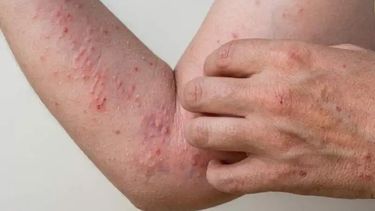 Chikungunyaen Jujuy (Foto ilustrativa) Chikungunyaen Jujuy (Foto ilustrativa)