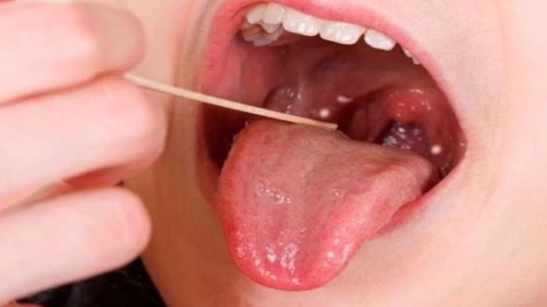 Es una bacteria Gram-positiva que es la causa bacteriana más frecuente de faringitis aguda.