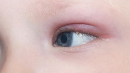 Cómo curar un orzuelo mucho más rápido