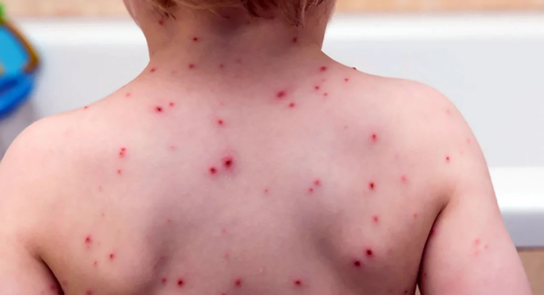 Alerta por sarampión. Alerta por sarampión.