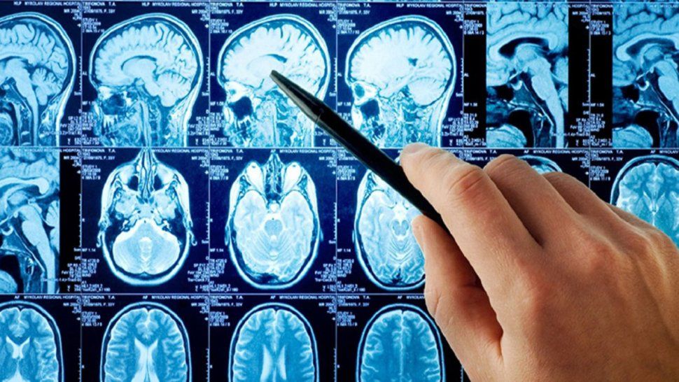 Trastornos neurológicos fueron registrados en pacientes recuperados de covid-19. /Foto ilustrativa