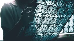 Un medicamento contra el Alzheimer logró enlentecer el deterioro cognitivo.&nbsp;
