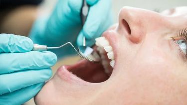 La gingivitis causa irritación, enrojecimiento e hinchazón de la parte de las encías que rodea la base de los dientes.